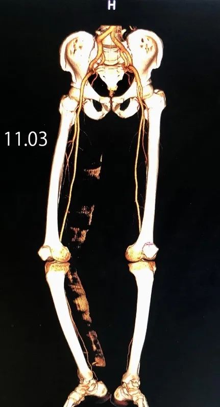 六院新闻我院援藏医生谢雪涛成功开展日喀则市首例股动脉破裂修复手术