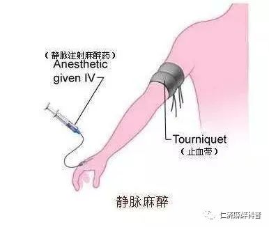 无痛胃镜检查后,我会"一麻不醒"吗?