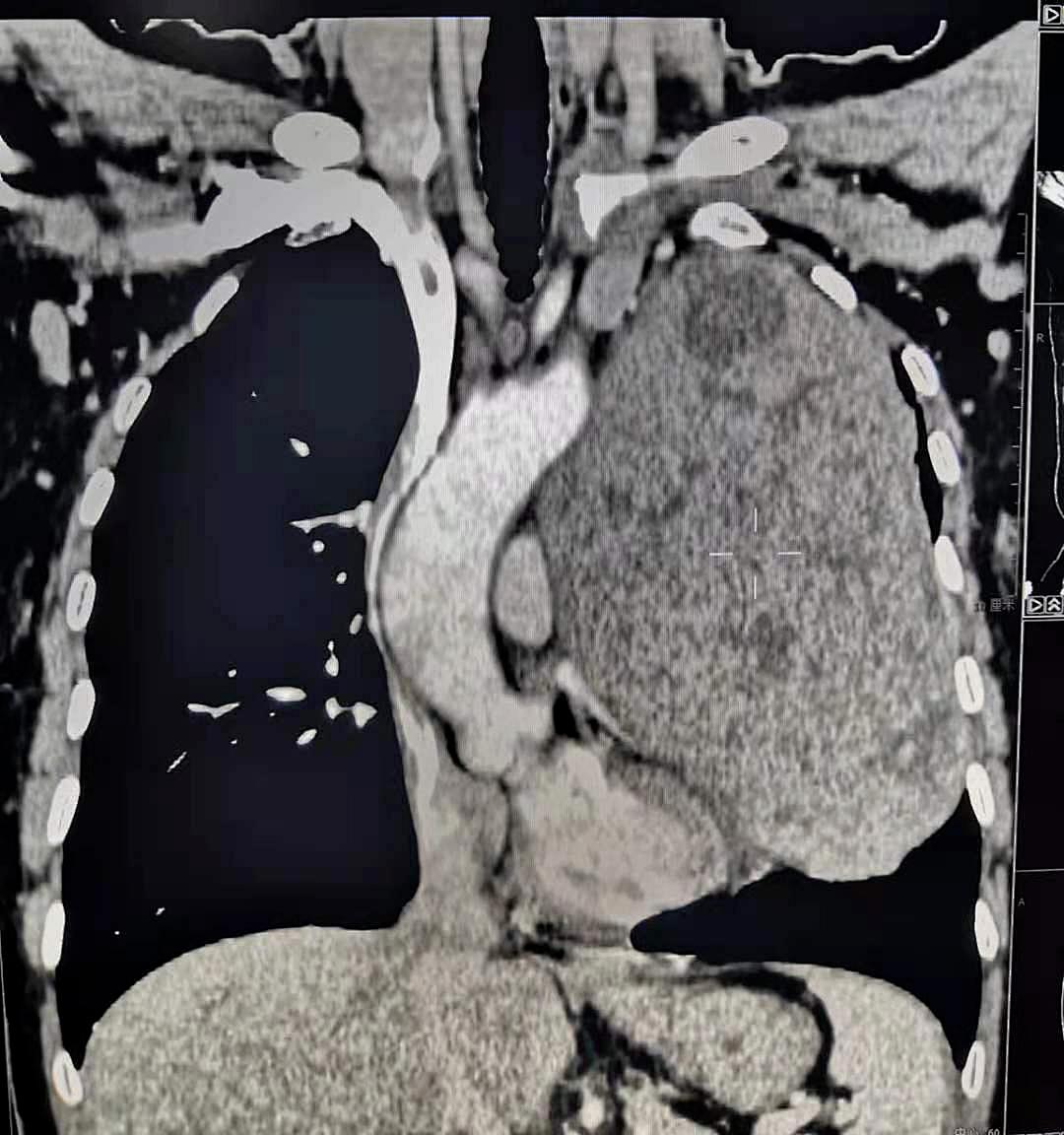 幾乎佔滿了整個左側胸腔,與心臟,左肺,胸主動脈,無名靜脈,左肺動靜脈