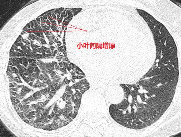 肺小叶间隔增厚图片