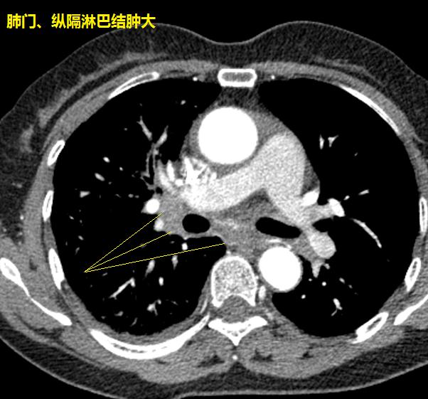 圖17-19綜上所述,單側小葉間隔增厚,肺部有較大結節,縱隔淋巴結多發