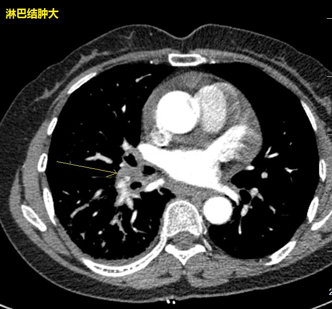 圖17-19綜上所述,單側小葉間隔增厚,肺部有較大結節,縱隔淋巴結多發