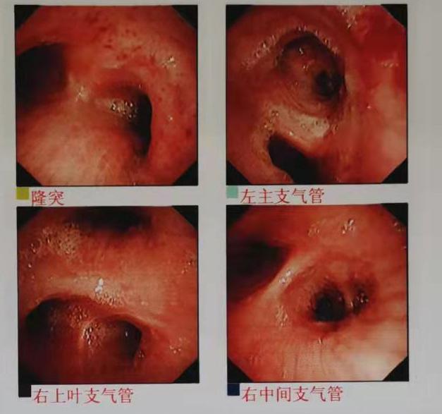 间质性肺炎还是癌性淋巴管炎一招搞定
