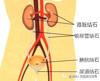 尿结石位置图片图片