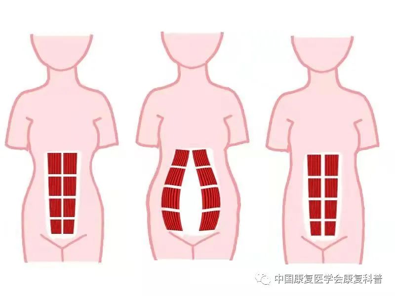 隨著胎兒在宮內生長,腹白線拉伸變薄弱,腹直肌間距離增大,腹部出現