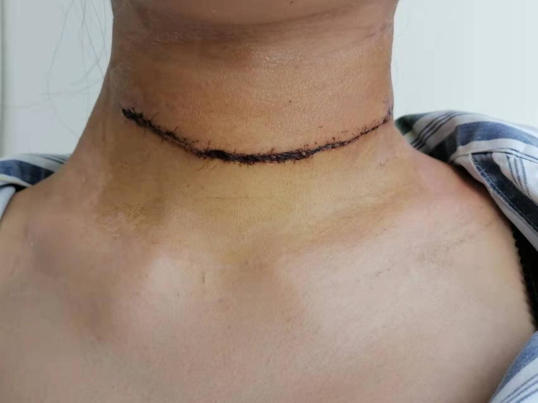 完成一例全甲状腺切除同期双侧改良性颈侧区淋巴结清扫术技术新突破
