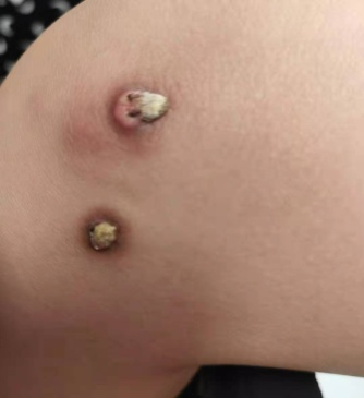 要重视孩子身上多处斑疹和皮损长达6年