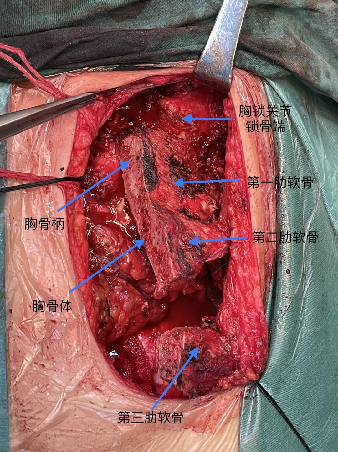 胸腺瘤微创手术图片