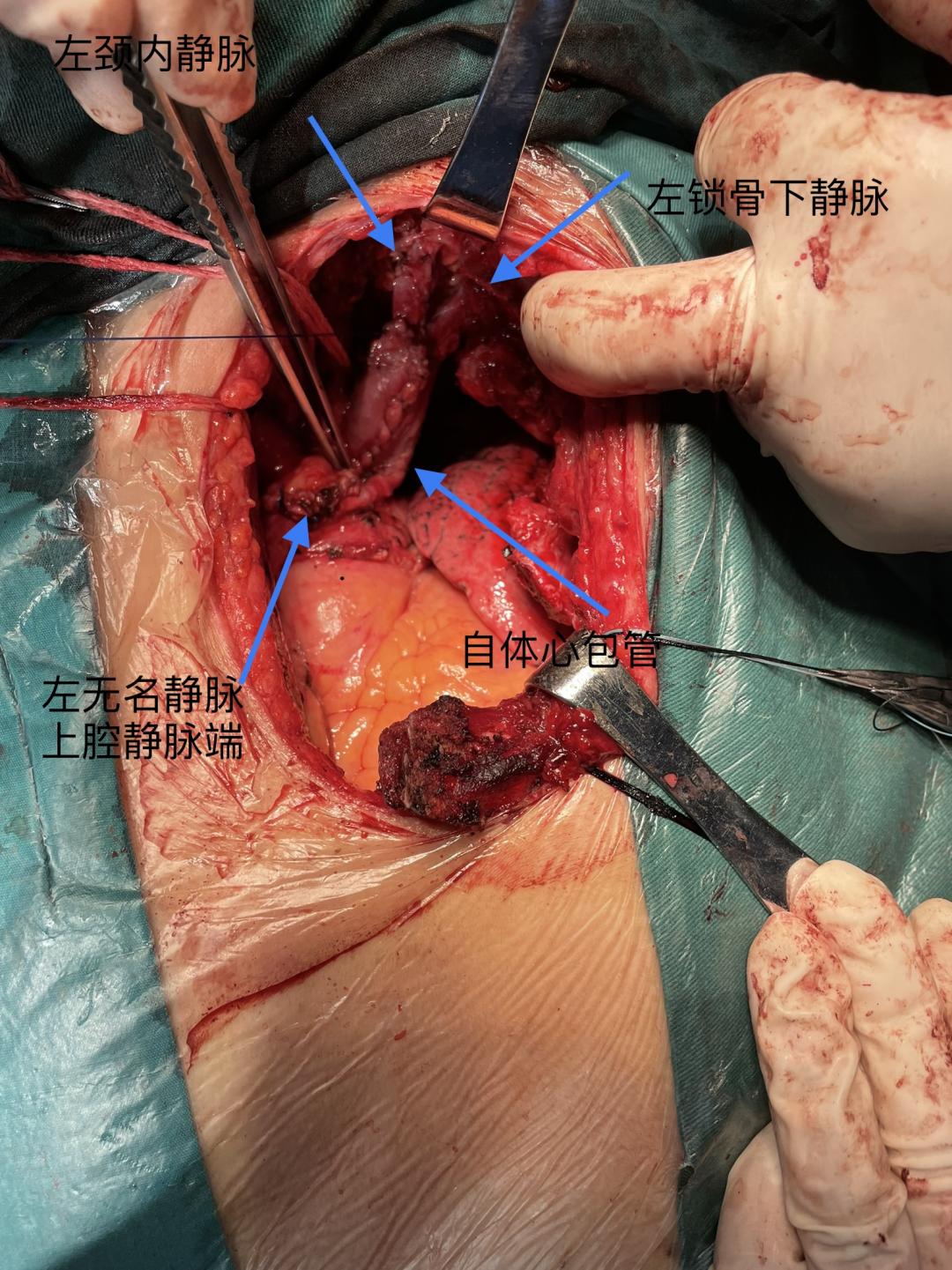 例高风险,高难度巨大复杂胸腺癌扩大切除术 自体心包管左无名静脉成