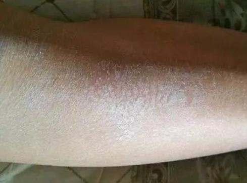 健康每次脱衣服腿上都有很多皮屑脱落提醒这种维生素该补了