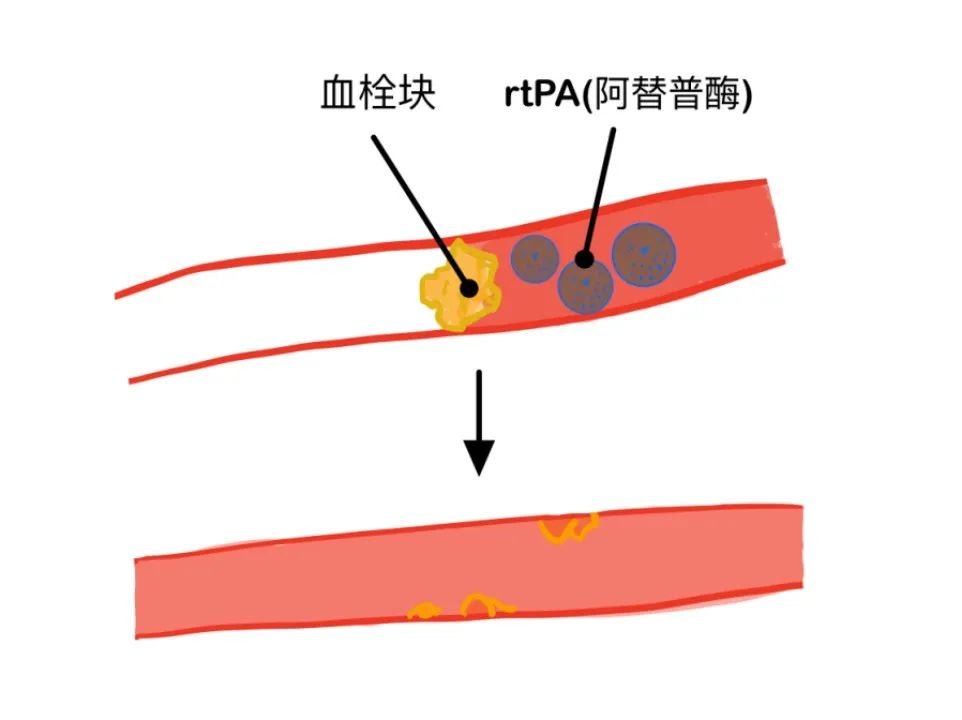 但用的药物是静脉溶栓药物,常用的一种叫做"阿替普酶"