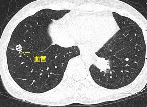 这个与血管相连的双肺多发小结节是怎样的神奇疾病