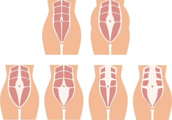 假如产后腹肌仍不能回到原先位置,就会形成产后腹直肌分离[7]