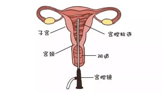 宫腔粘连节育环图片图片