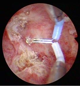 不孕症的天敌宫腔粘连碎碎念