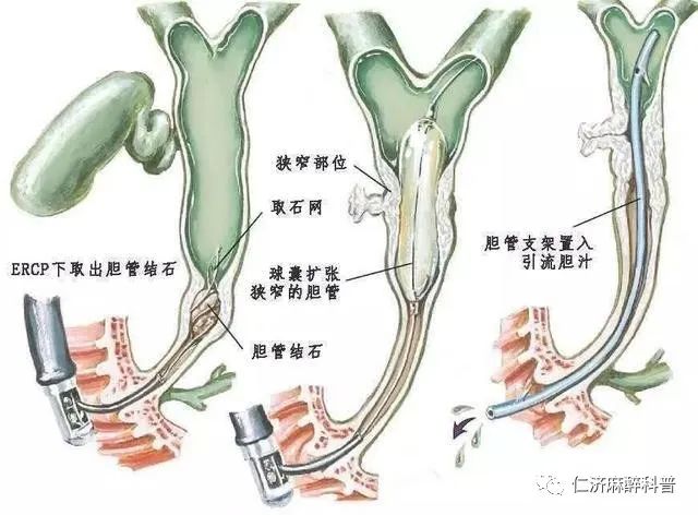 结石的分布,胆道狭窄的部位与性质,有无胆管畸形,更能早期发现壶腹癌