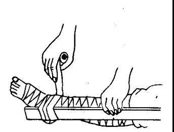 医学科普 为什么骨折要用夹板固定