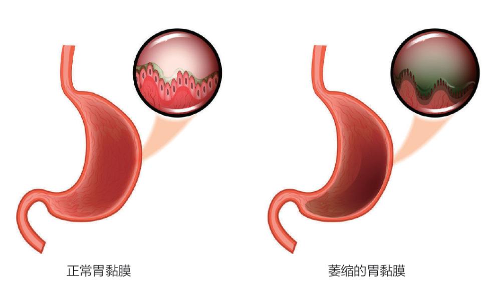 胃因何而萎縮