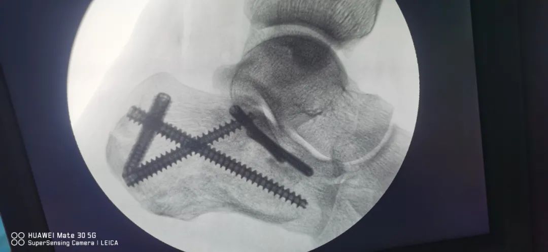 跟骨骨折钢板固定图片图片
