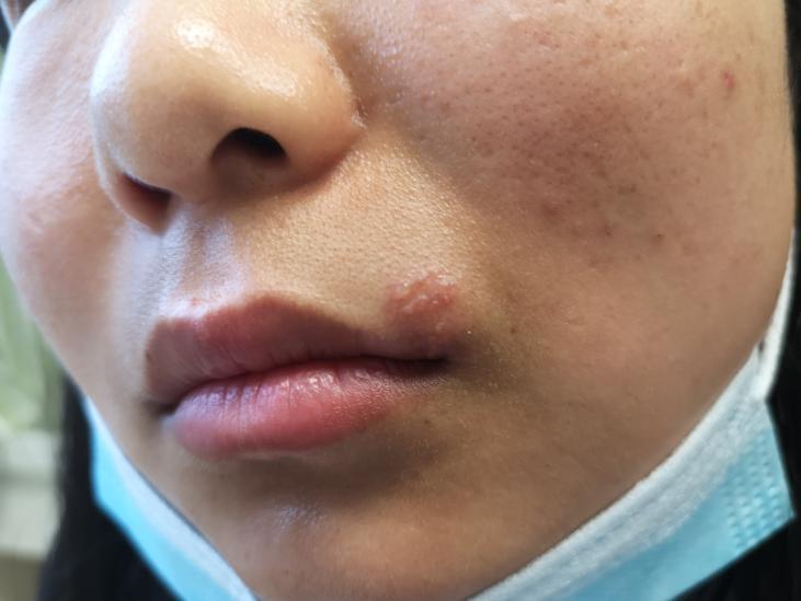 hsv-1最易引起口唇疱疹,其复发率大约为30%~50%;hsv-2导致的生殖器