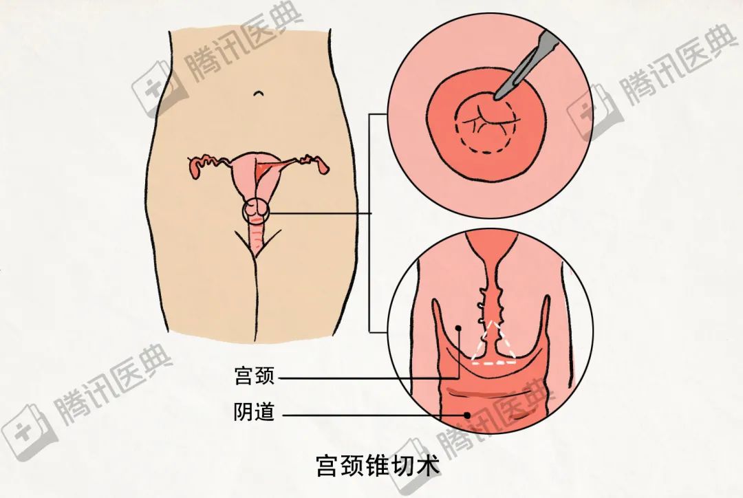 宫颈又扁又硬像舌头图片