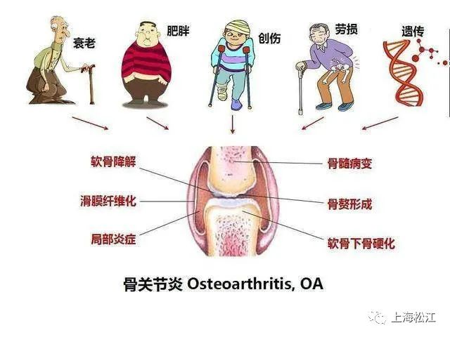 關節僵硬疼痛松江醫生教你這樣改善