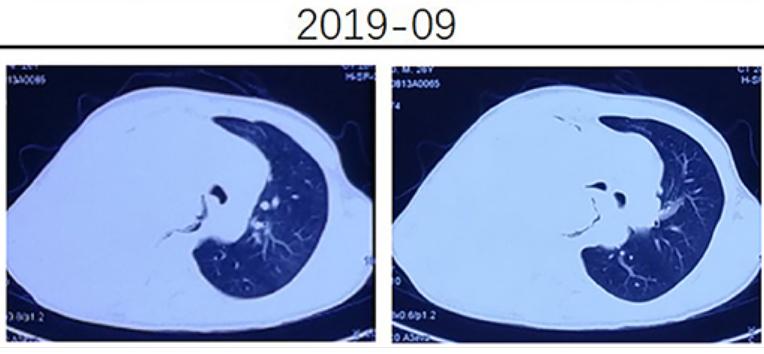 這種肺部良性腫瘤會轉移甚至會危及生命