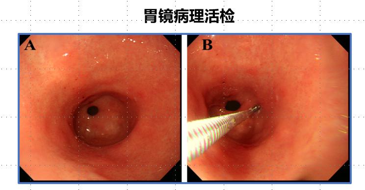 怎么测胃里有没有幽门螺旋杆菌 431.jpg