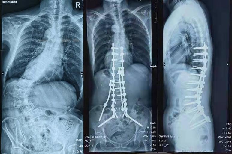 多節段腰椎間盤突出,腰椎管狹窄合併嚴重脊柱側彎的複雜病例逐年增多