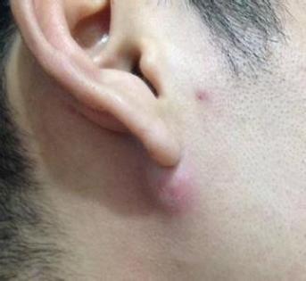耳廓皮肤疖肿图片