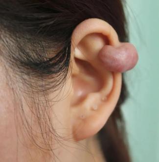 耳廓疖肿图片图片