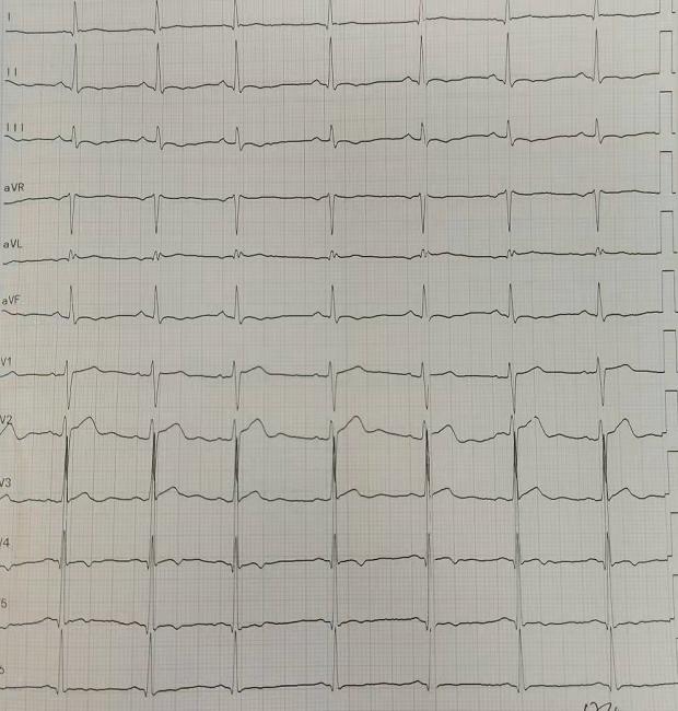 27歲小夥持續胸痛肌鈣蛋白41ngml真兇卻不是心梗