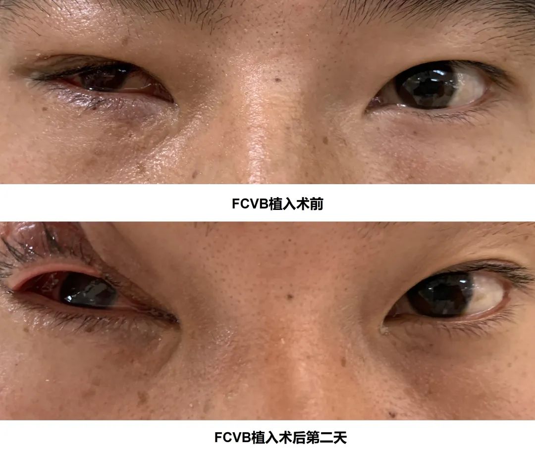 绝处逢生挽救濒临摘除的眼球