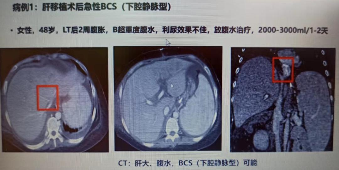 门脉高压性肠病图片