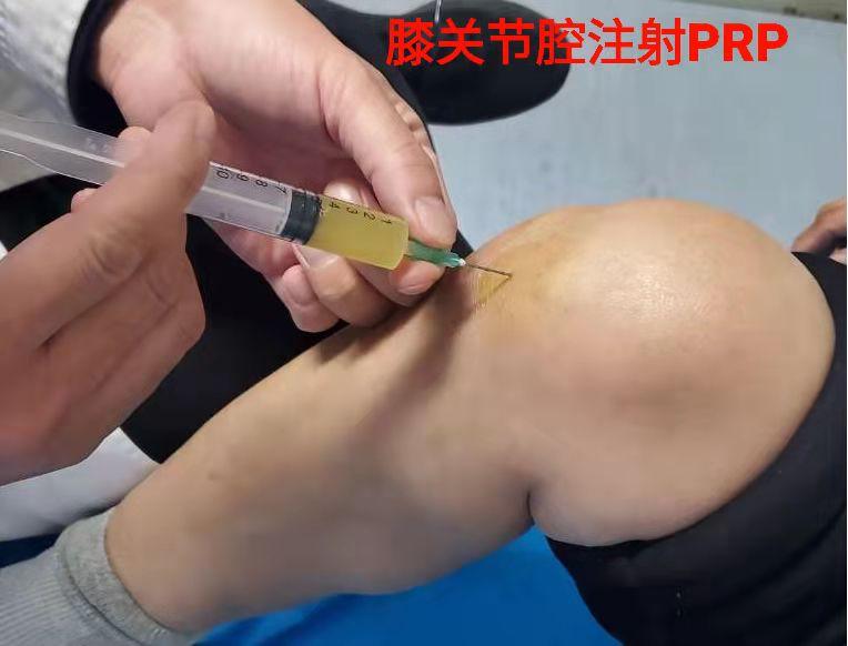 膝关节骨性关节炎的新疗法富血小板血浆prp