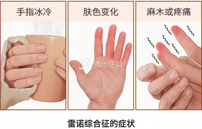 先苍白,随后发紫,潮红,伴发痒,刺痛或烧灼感的症状,要小心雷诺综合征