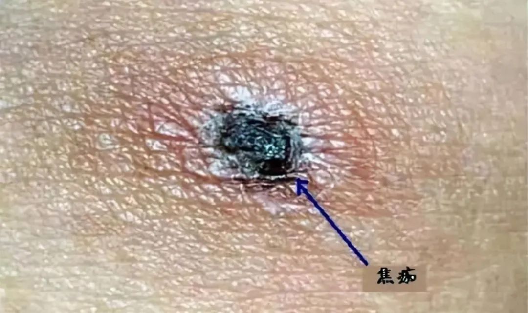 撸猫后患上恙虫病送进icu,医生带你认识恙虫病的防护