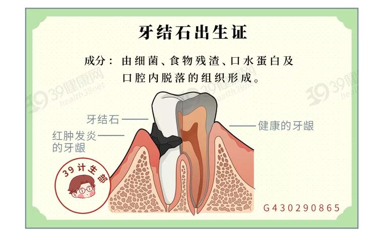 牙结石的分度图片图片