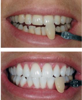 如果牙齿就该是淡黄色,难道我们天生牙白的才不健康?