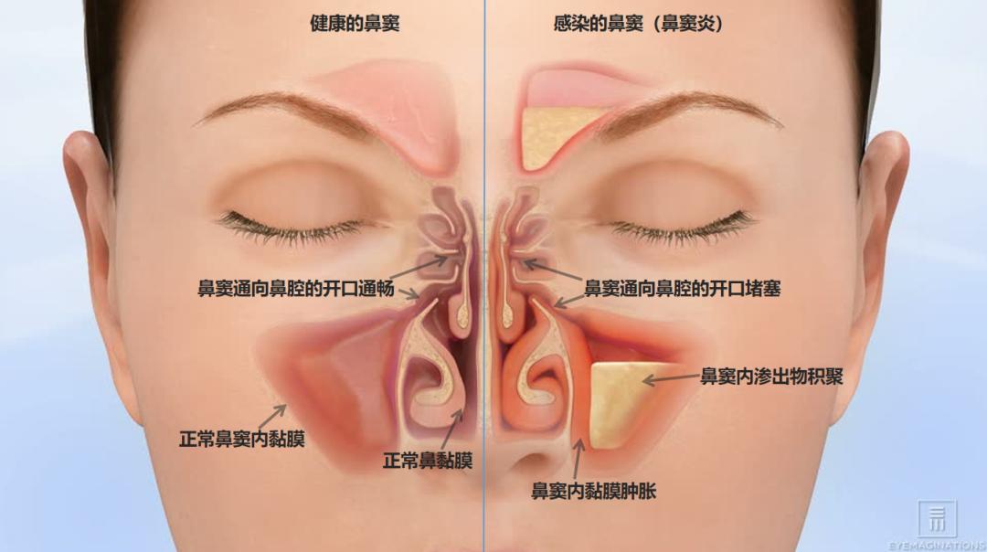 鼻窦位置示意图图片