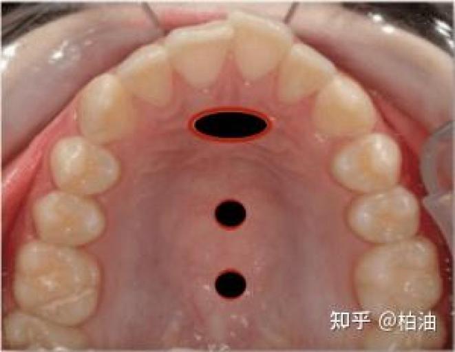 舌头在口腔中的位置图图片