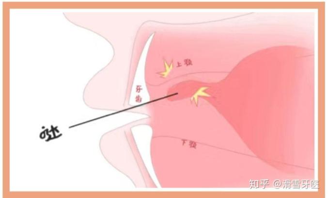 彈舌訓練將舌吸到上顎,迅速離開發出彈響,像馬蹄「噠噠」聲.