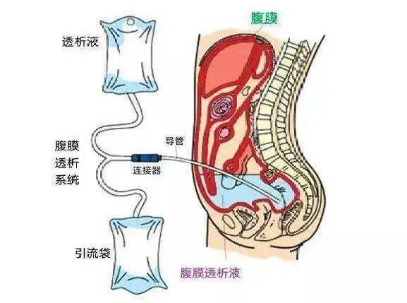 小南話科普尿毒症患者只有血液透析一個選擇嗎