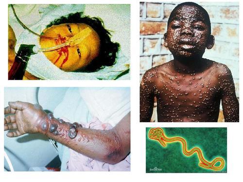 伊波拉病毒感染者图片图片