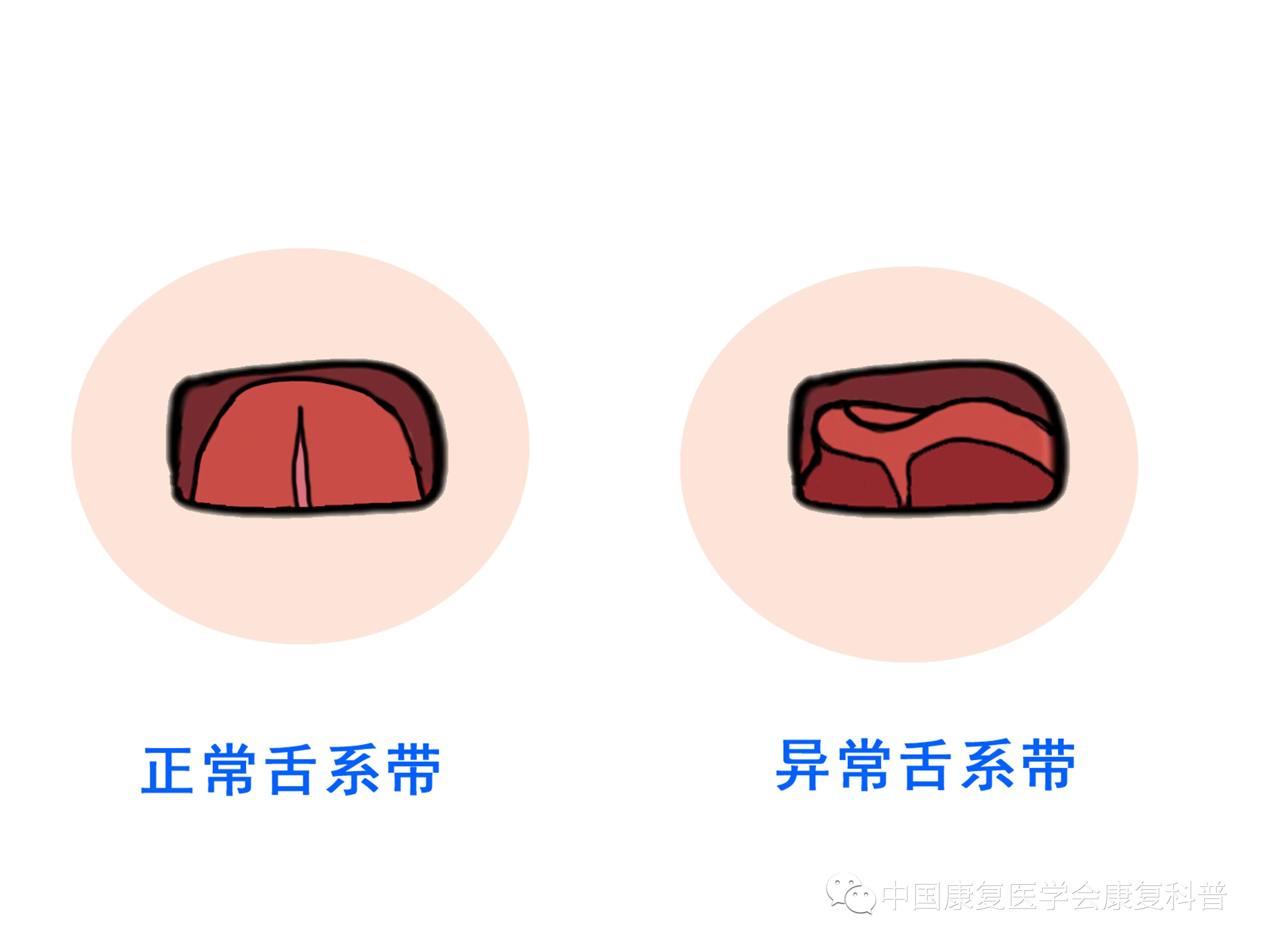 舌繫帶過短會影響孩子的發音,表現為發音不清,但是不會影響寶寶言語的