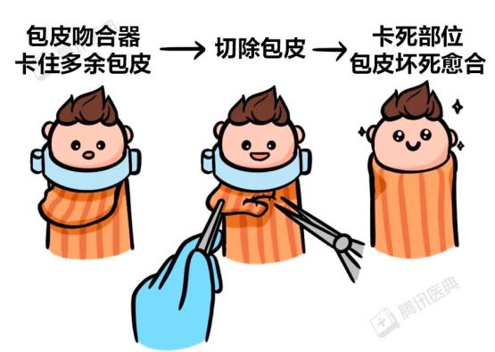 来源:自己画的)科普时间:包皮手术主要有3种[2],门诊就能搞定,5~10