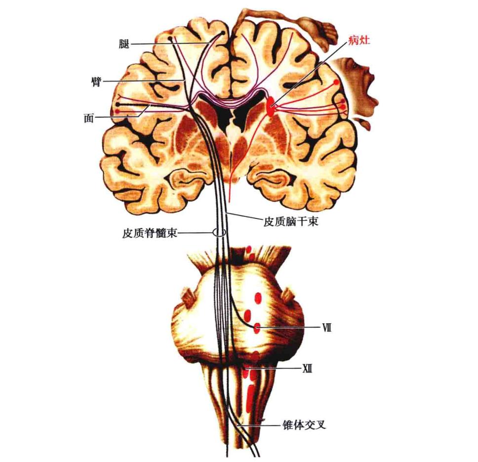 胼胝体在脑部的位置图图片