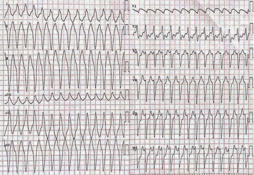 典型室速心电图图片图片