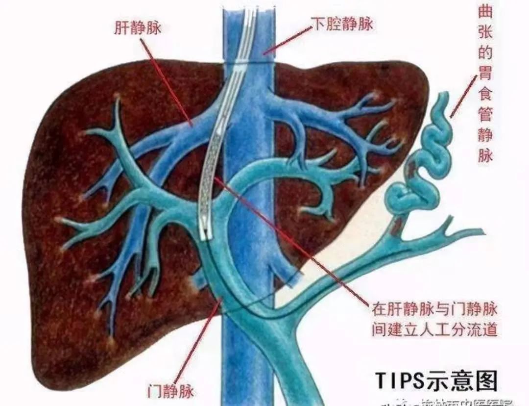 我院胸外科消化介入治疗组董剑群团队成功独立完成我市首例tipss手术