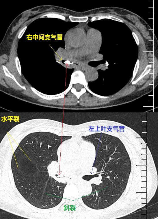 咳嗽一年找不到原因原来是钙化惹的祸